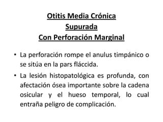Otitis Media Crónica
Supurada
Con Perforación Marginal
• La perforación rompe el anulus timpánico o
se sitúa en la pars fláccida.
• La lesión histopatológica es profunda, con
afectación ósea importante sobre la cadena
osicular y el hueso temporal, lo cual
entraña peligro de complicación.

 