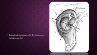 • Colesteatoma congénito del cuadrante
anterosuperior.
 
