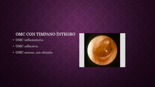 OMC CON TIMPANO ÍNTEGRO
• OMC inflamatorio.
• OMC adhesiva.
• OMC serosa, con efusión.
 