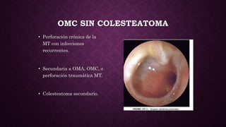 OMC SIN COLESTEATOMA
• Perforación crónica de la
MT con infecciones
recurrentes.
• Secundaria a OMA, OMC, o
perforación traumática MT.
• Colesteatoma secundario.
 