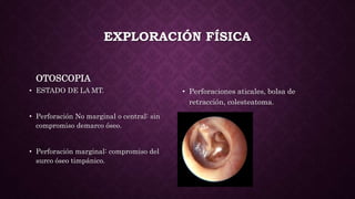 EXPLORACIÓN FÍSICA
OTOSCOPIA
• ESTADO DE LA MT.
• Perforación No marginal o central: sin
compromiso demarco óseo.
• Perforación marginal: compromiso del
surco óseo timpánico.
• Perforaciones aticales, bolsa de
retracción, colesteatoma.
 