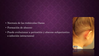 • Necrosis de las trabéculas Oseas
• Formación de absceso
• Puede evolucionar a periostitis y absceso subperiostico
o infección intracraneal
 