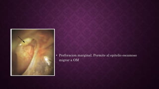 • Perforacion marginal. Permite al epitelio escamoso
migrar a OM
 