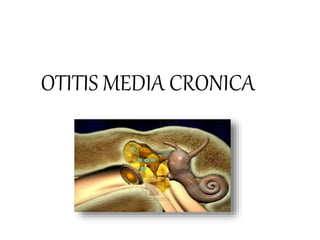 OTITIS MEDIA CRONICA
 