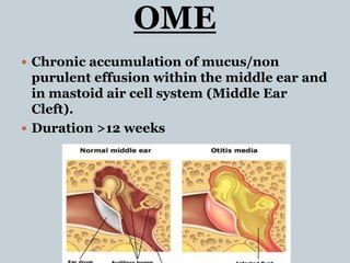 OME
 Chronic accumulation of mucus/non
purulent effusion within the middle ear and
in mastoid air cell system (Middle Ear
Cleft).
 Duration >12 weeks
 