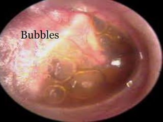 Bubbles
 