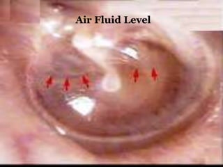 Air Fluid Level
 