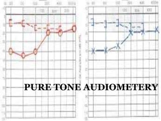 PURE TONE AUDIOMETERY
 