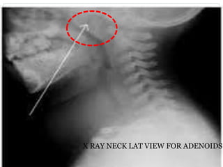 X RAY NECK LAT VIEW FOR ADENOIDS
 