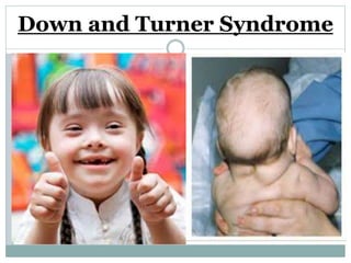 Down and Turner Syndrome
 
