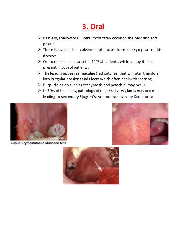 dental Management of Systemic Lupus Erythematous & Scleroderma