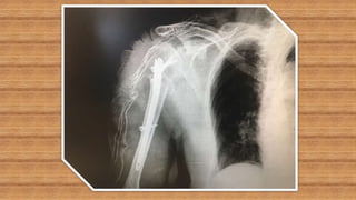 Humeral fractures