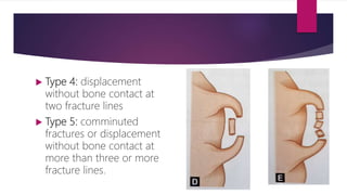  Type 4: displacement
without bone contact at
two fracture lines
 Type 5: comminuted
fractures or displacement
without bone contact at
more than three or more
fracture lines.
 