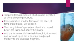  Temporal fascia is exposed which can be identified
as white glistening structure.
 Incision is taken into the fascia and the fibers of
temporalis muscles will be seen.
 Then long bristow’s periosteal elevator is passed
below the fascia and above the muscle
 And the instrument is inserted through it, downward
and forward, tip of the instrument is adjusted
medially to the displaced fragment.
 
