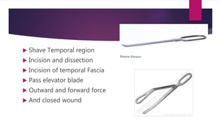  Shave Temporal region
 Incision and dissection
 Incision of temporal Fascia
 Pass elevator blade
 Outward and forward force
 And closed wound
 