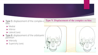  Type 5: displacement of the complex en
bloc
 Medial
 Inferior
 Lateral (rare)
 Type 6: displacement of the orbitoantral
partition
 Inferiorly
 Superiorly (rare)
 