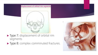 Type 7: displacement of orbital rim
segments
 Type 8: complex comminuted fractures.
 