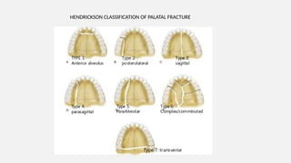 Classifications used in Oral and maxillofacial surgery.pptx