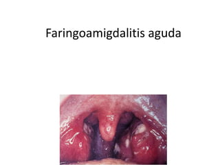 Faringoamigdalitis aguda
 