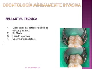 SELLANTES TÉCNICA

    1.   Diagnóstico del estado de salud de
         surcos y fisuras.
    2.   Profilaxis.
    3.   Lavado y secado
    4.   Confirmar diagnóstico.
.




                     Dra. Pilar Maddaleno Julía.   38
 