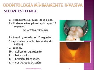 SELLANTES TÉCNICA

  5.- Aislamiento adecuado de la pieza.
  6.- Grabado acido gel de la pieza por 15
       segundos
              ac. ortofosforico 37%.
  4. Enjuague y secado de la superficie.


  7.- Lavado y secado por 30 segundos.
  8.-Aplicación del sellante
  5. Aplicación de adhesivo (resina de
       enlace)
  9.- Secado.
  10.- Aplicación del sellante.
  6. Fotopolimerización.
  11.- Fotocurado.
  12.- Revisión del sellante.
  13.- Control de la oclusión.
  7. Verificación del Sellado y control de Oclusión

                  Dra. Pilar Maddaleno Julía.         39
 