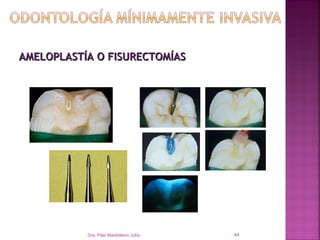 AMELOPLASTÍA O FISURECTOMÍAS




           Dra. Pilar Maddaleno Julía.   44
 