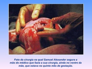 Foto da cirurgia na qual Samuel Alexander segura a mão do médico que fazia a sua cirurgia, ainda no ventre da mãe, que estava no quinto mês de gestação. 