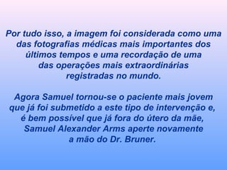 Por tudo isso, a imagem foi considerada como uma 
das fotografias médicas mais importantes dos 
últimos tempos e uma recordação de uma 
das operações mais extraordinárias 
registradas no mundo. 
Agora Samuel tornou-se o paciente mais jovem 
que já foi submetido a este tipo de intervenção e, 
é bem possível que já fora do útero da mãe, 
Samuel Alexander Arms aperte novamente 
a mão do Dr. Bruner. 
 