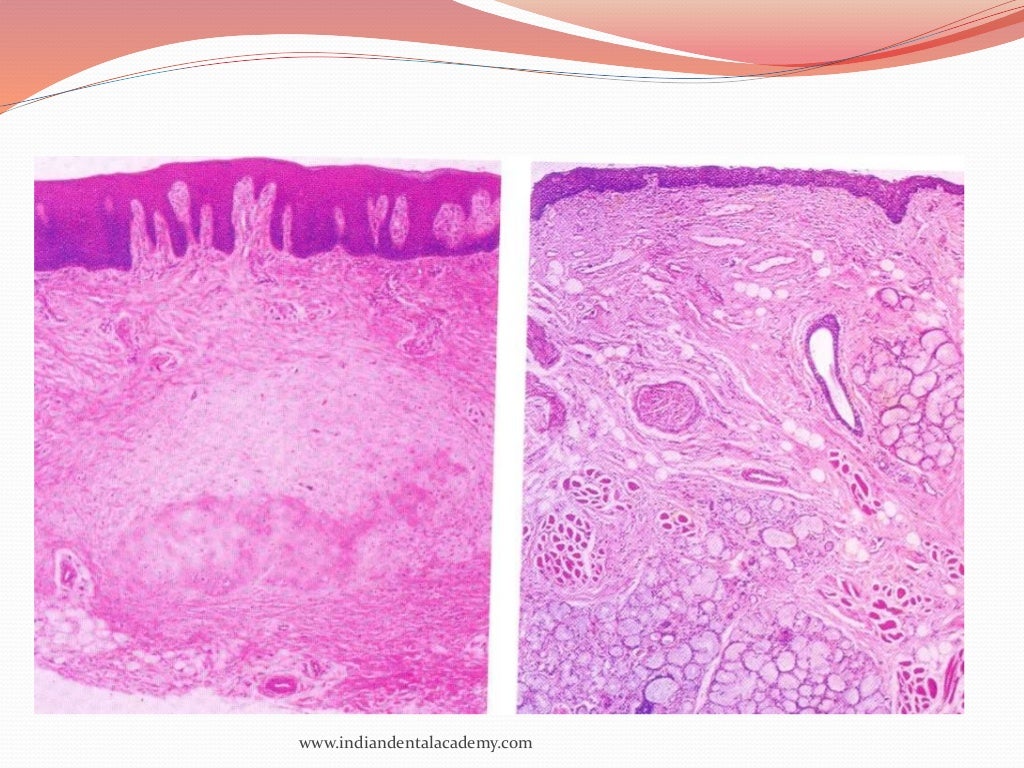 oral mucous membranes2 /certified fixed orthodontic courses by India…