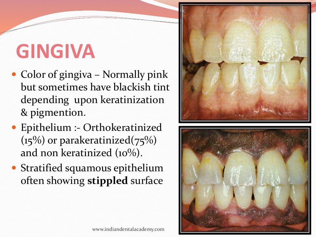 oral mucous membranes2 /certified fixed orthodontic courses by India…