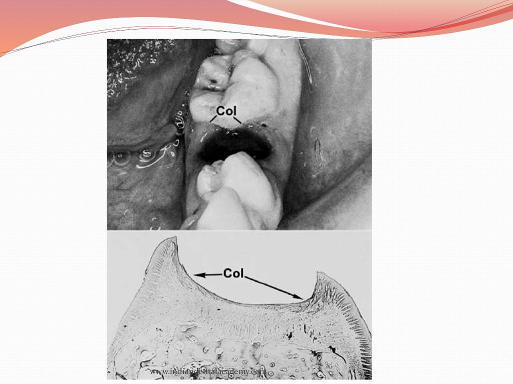 oral mucous membranes2 /certified fixed orthodontic courses by India…
