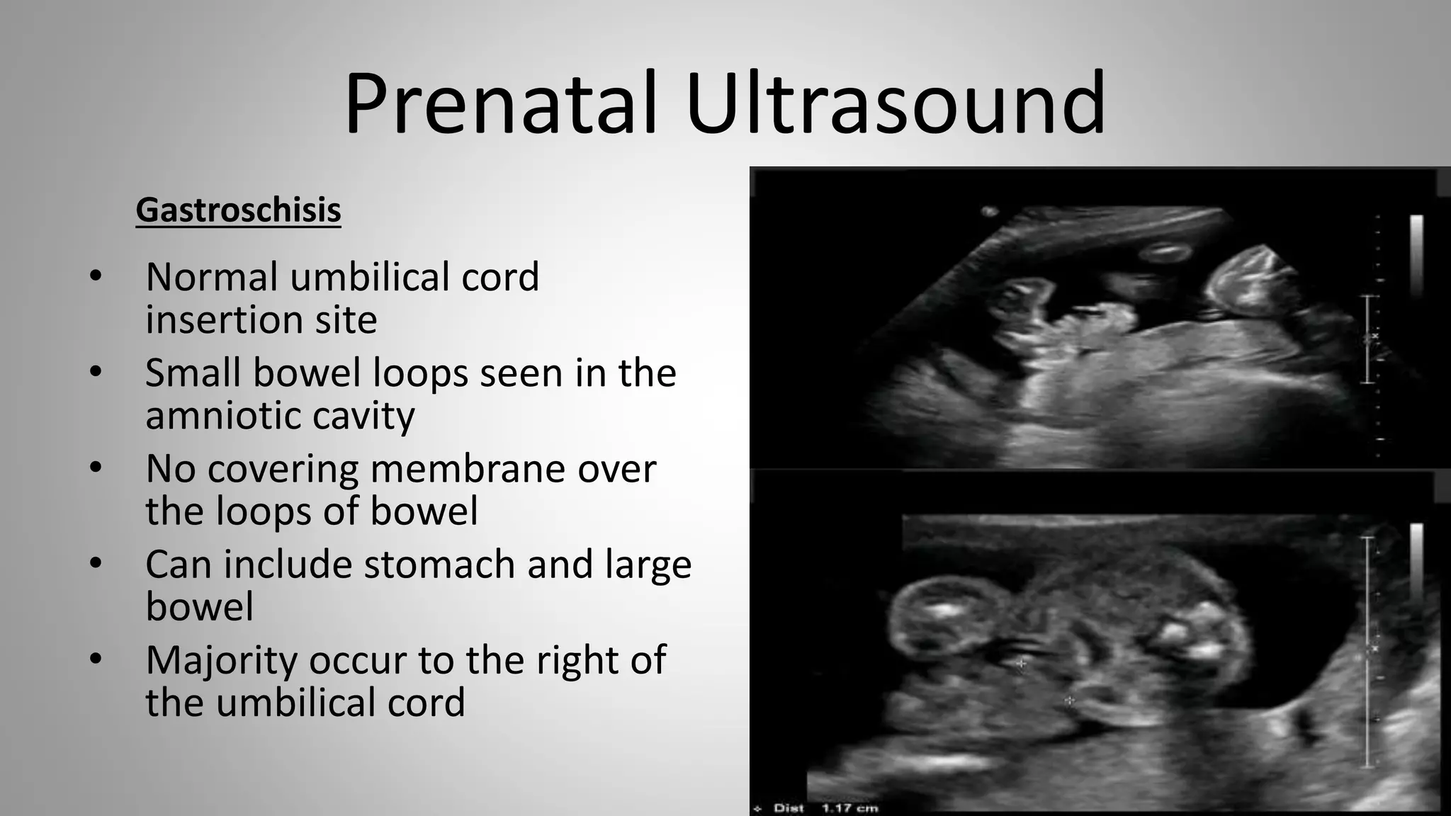 Omphalocele vs gastroschisis | PPT