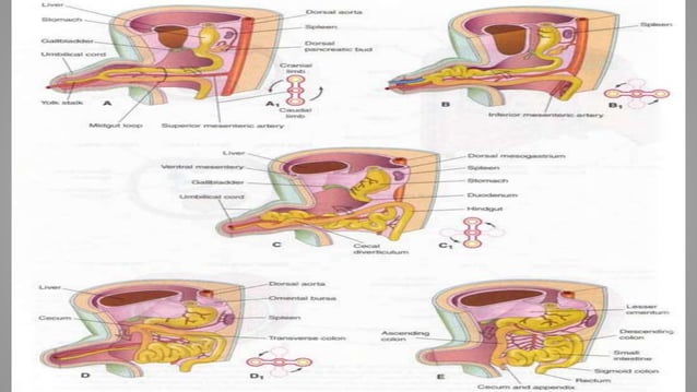 Omphalocele vs gastroschisis | PPTX | Pregnancy | Reproductive Health
