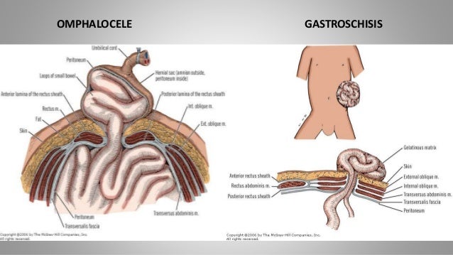 Omphalocele vs gastroschisis