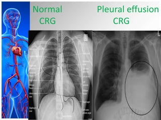 Normal Pleural effusion
CRG CRG
 
