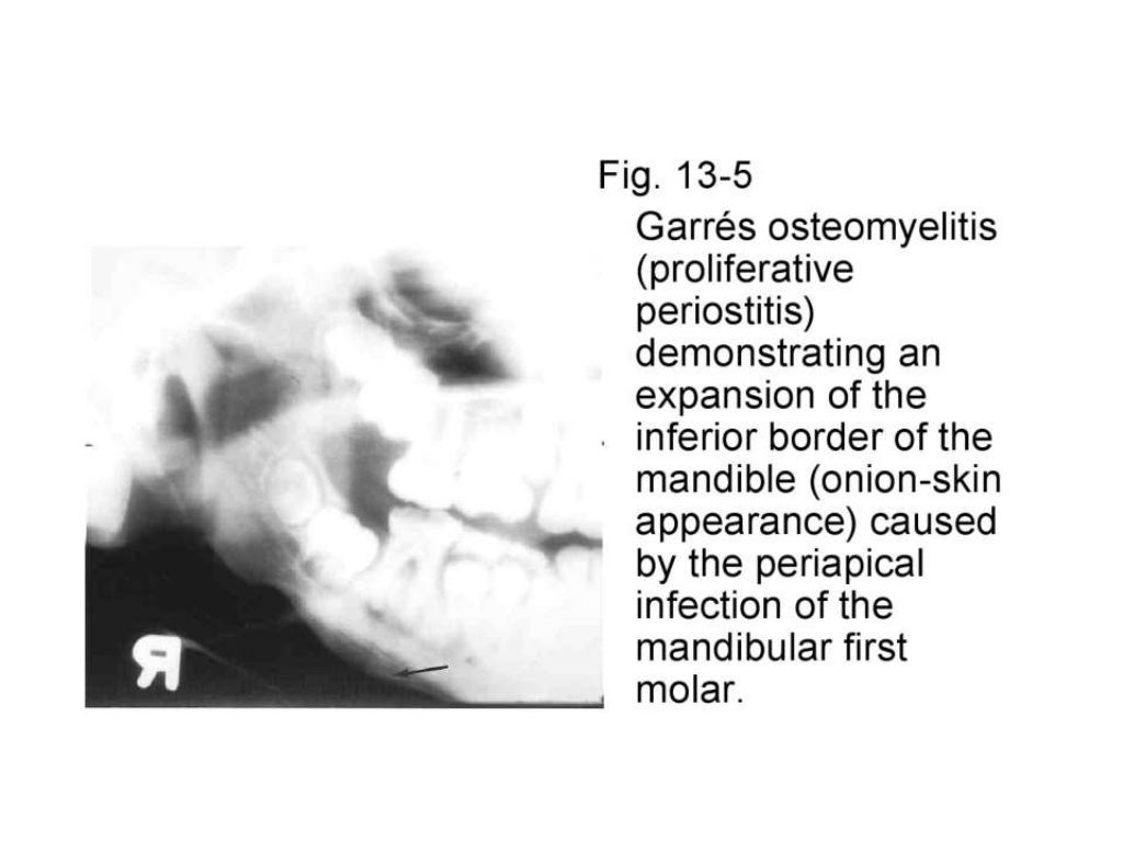 Osteomyelitis of jawdepartment of oral medicine and radiology