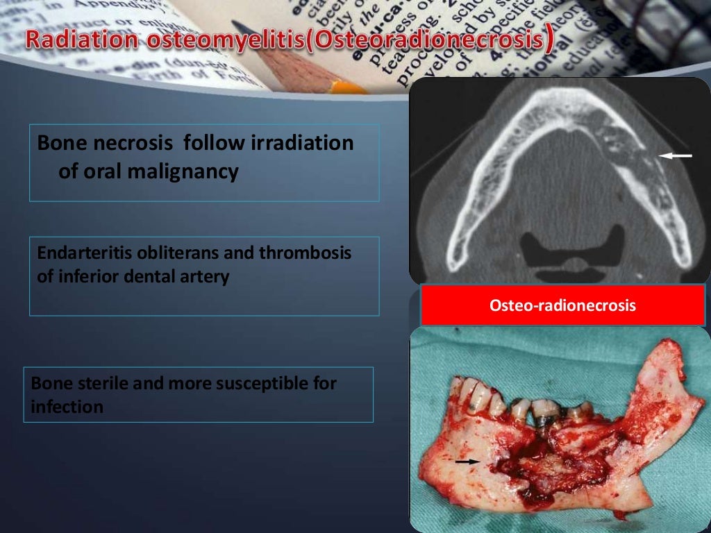 Osteomyelitis of jawdepartment of oral medicine and radiology