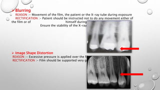 Blurring
REASON :- Movement of the film, the patient or the X-ray tube during exposure
RECTIFICATION :- Patient should be instructed not to do any movement either of
the film or of himself during the radiograph.
Ensure the stability of the X-ray tube.
 Image Shape Distortion
REASON :- Excessive pressure is applied over the film.
RECTIFICATION :- Film should be supported very gently.
 