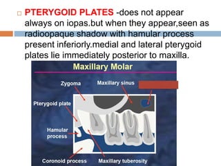  PTERYGOID PLATES -does not appear
always on iopas.but when they appear,seen as
radioopaque shadow with hamular process
present inferiorly.medial and lateral pterygoid
plates lie immediately posterior to maxilla.
 