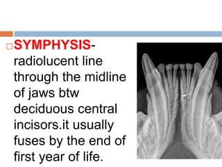 SYMPHYSIS-
radiolucent line
through the midline
of jaws btw
deciduous central
incisors.it usually
fuses by the end of
first year of life.
 