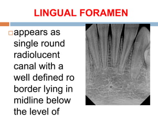 LINGUAL FORAMEN
appears as
single round
radiolucent
canal with a
well defined ro
border lying in
midline below
the level of
 