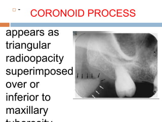 CORONOID PROCESS
 -
appears as
triangular
radioopacity
superimposed
over or
inferior to
maxillary
 