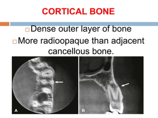 CORTICAL BONE
 Dense outer layer of bone
 More radioopaque than adjacent
cancellous bone.
 