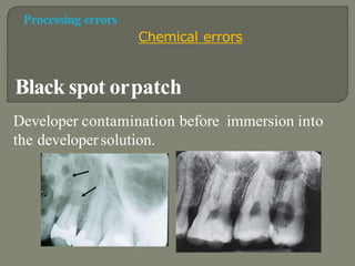 RADIOGRAPHIC ARTIFACTS | PPTX