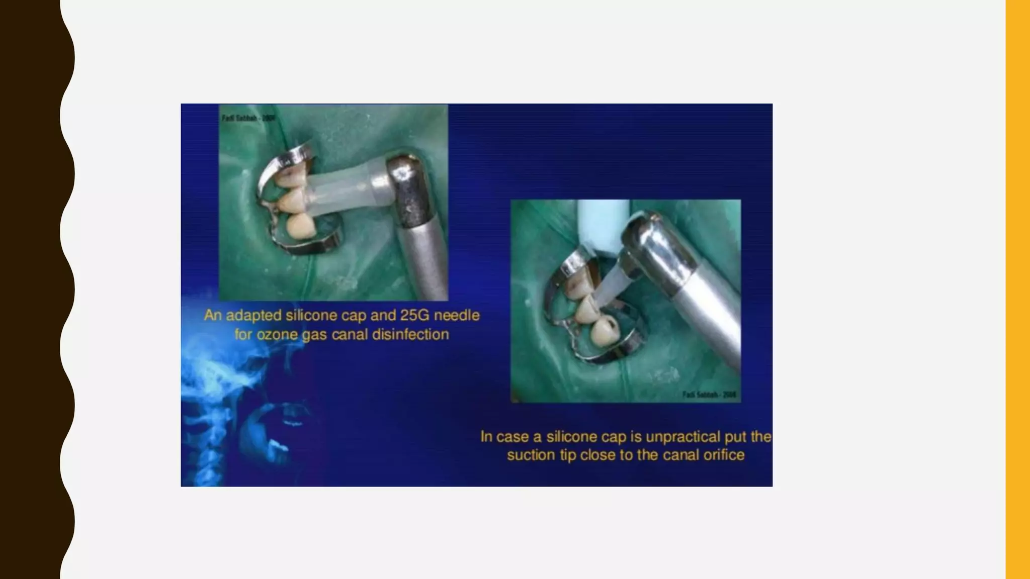 ozone therapy in dentistry