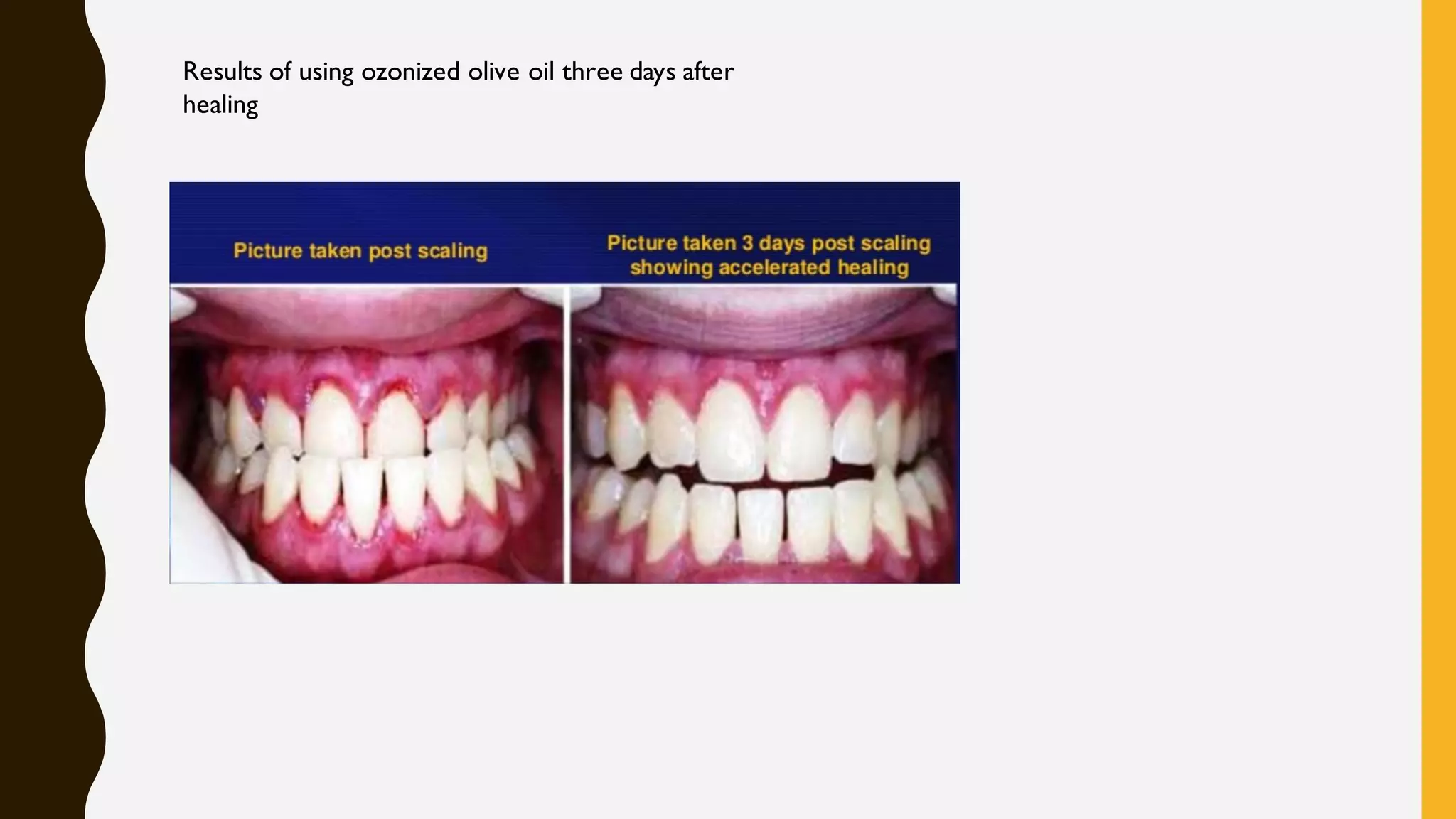ozone therapy in dentistry