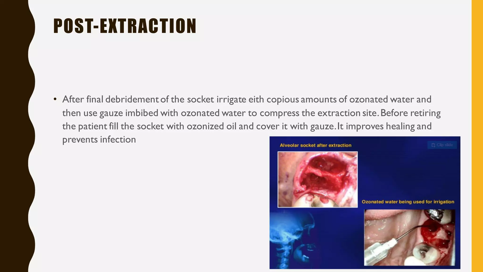 ozone therapy in dentistry