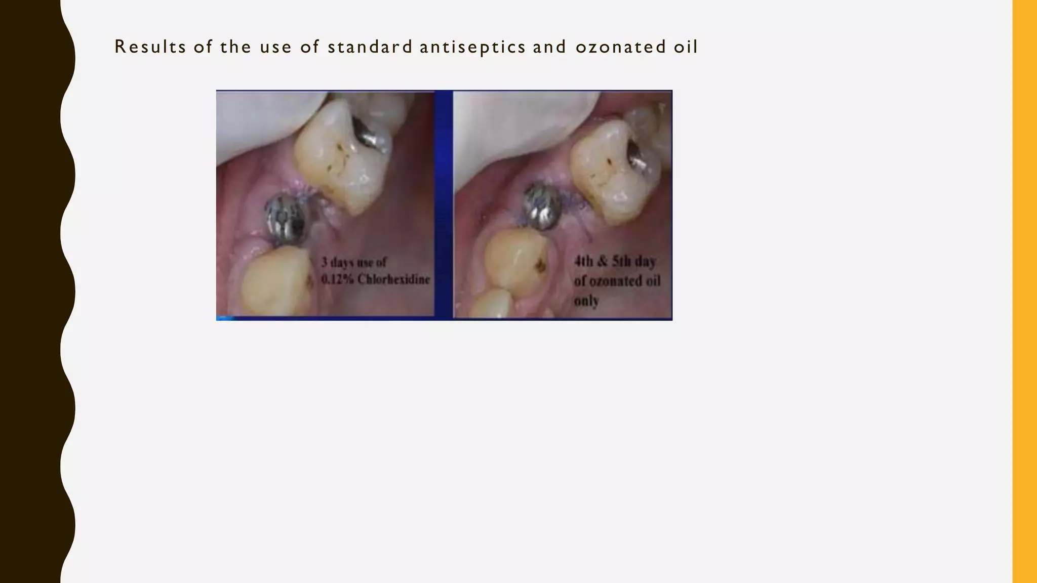 ozone therapy in dentistry
