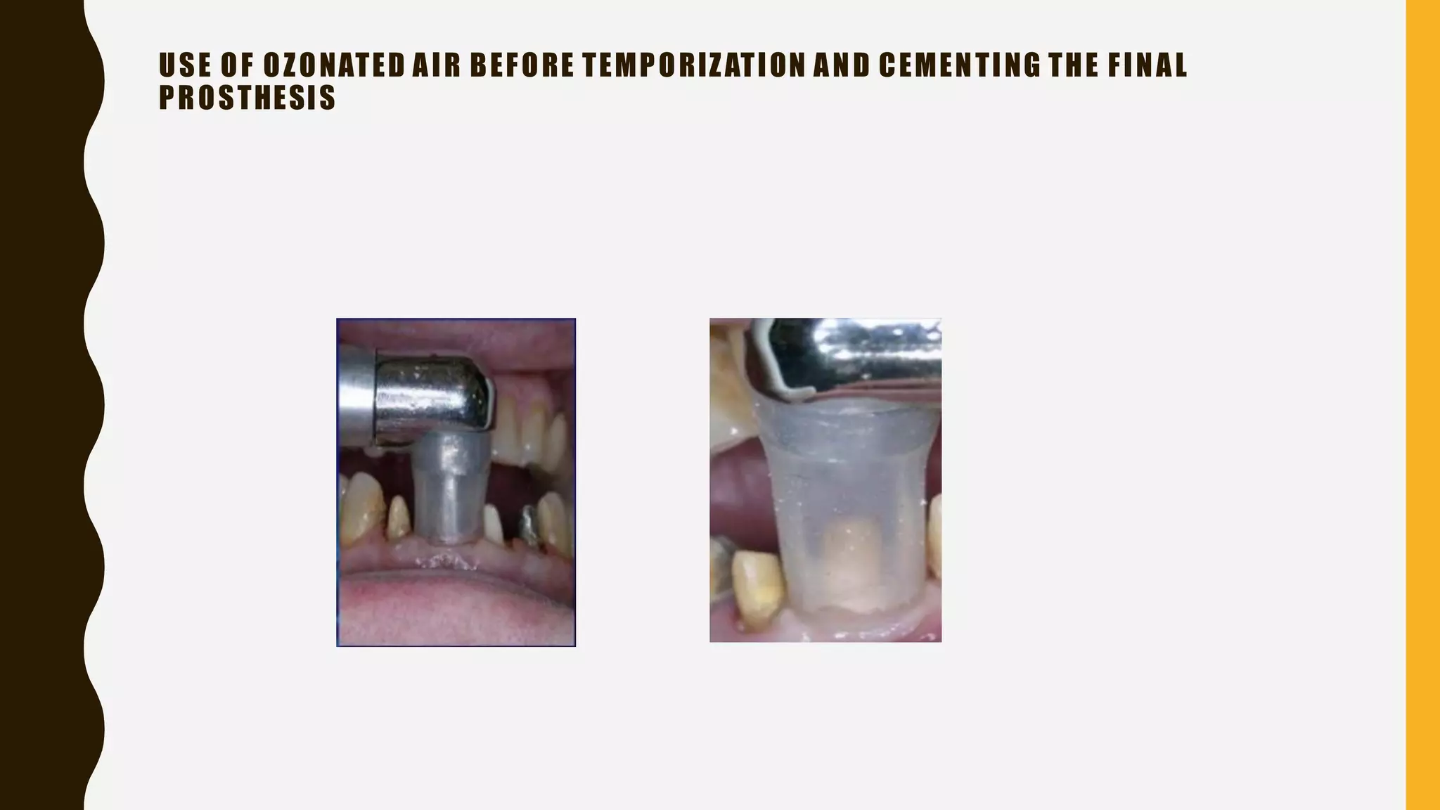 ozone therapy in dentistry