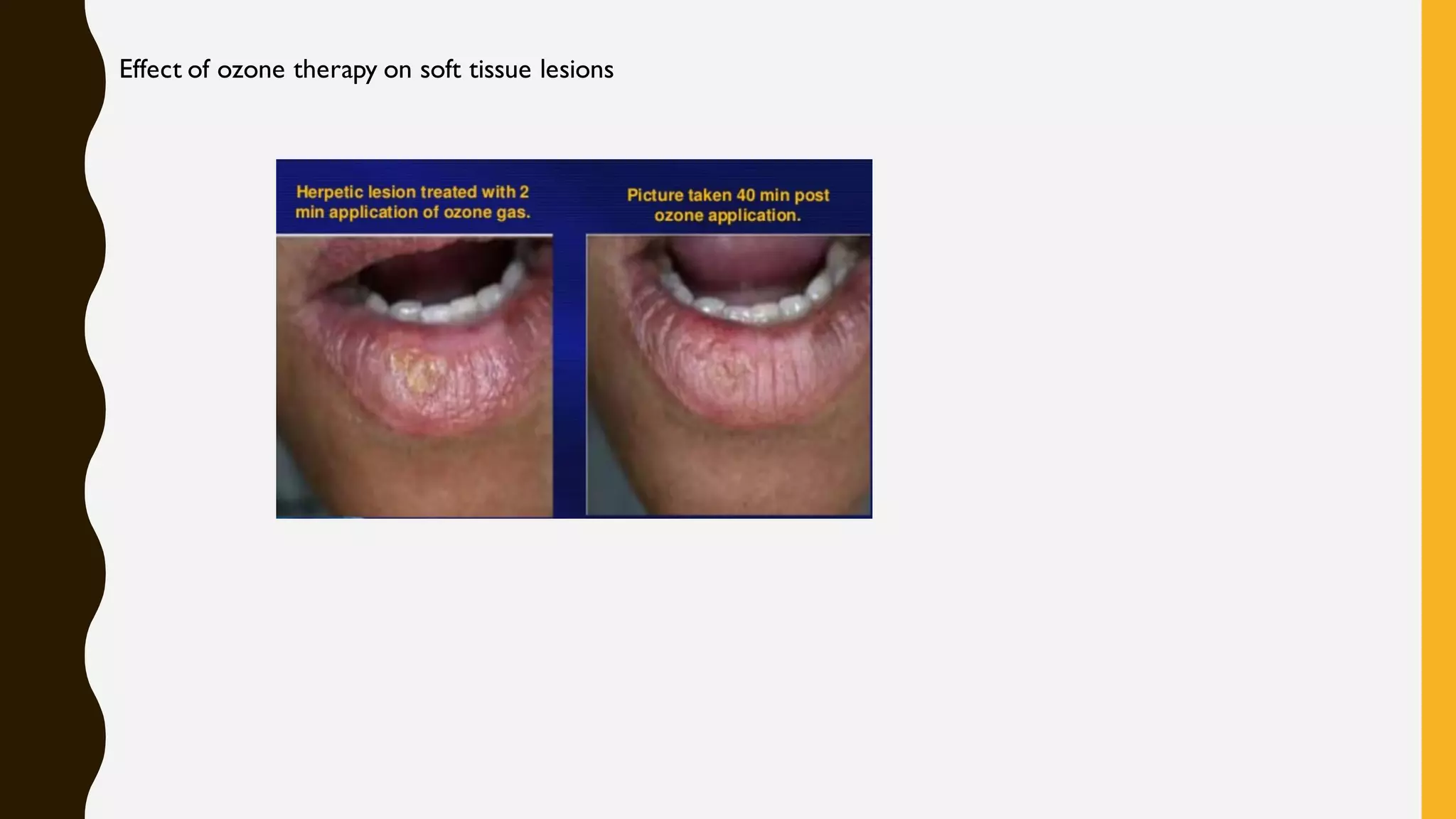 ozone therapy in dentistry